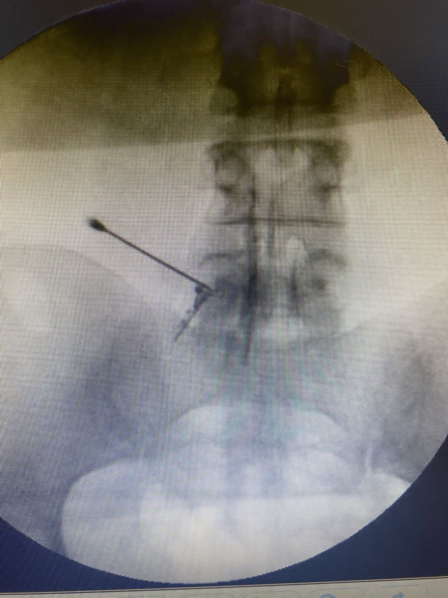 Aguja posicionada bajo fluoroscopia