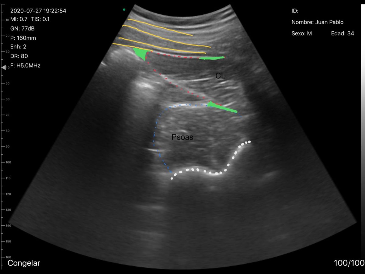 Ultrasonido región lumbar