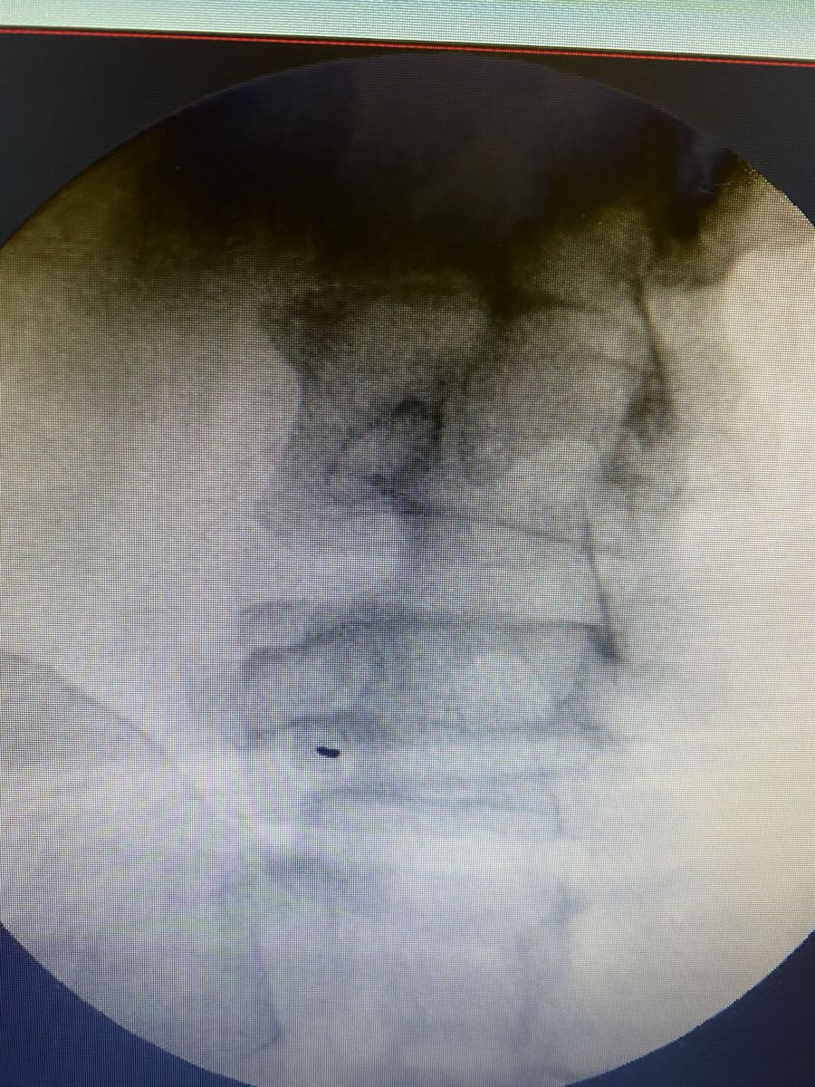 Fluoroscopia columna lumbar