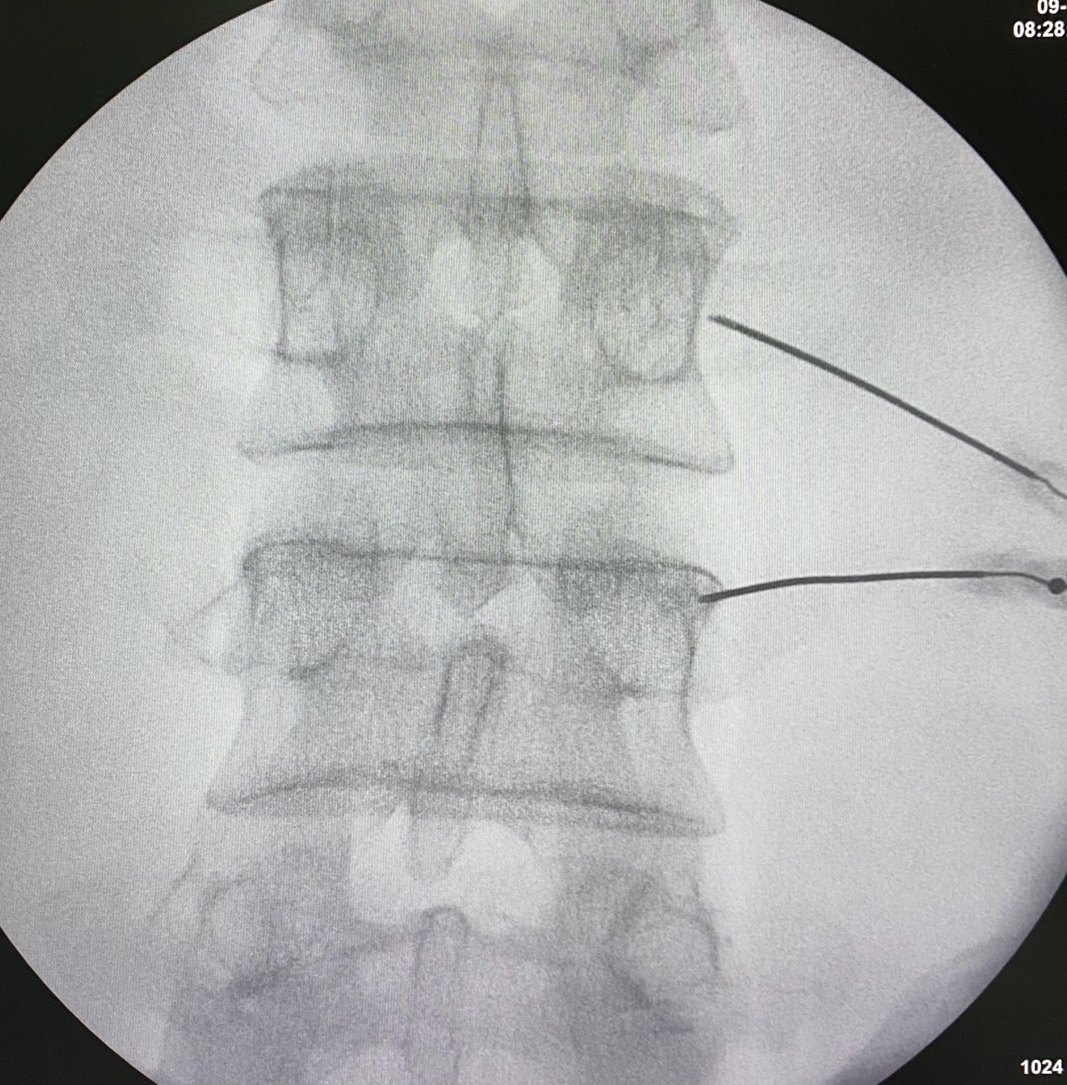 Radiofrecuencia lumbar
