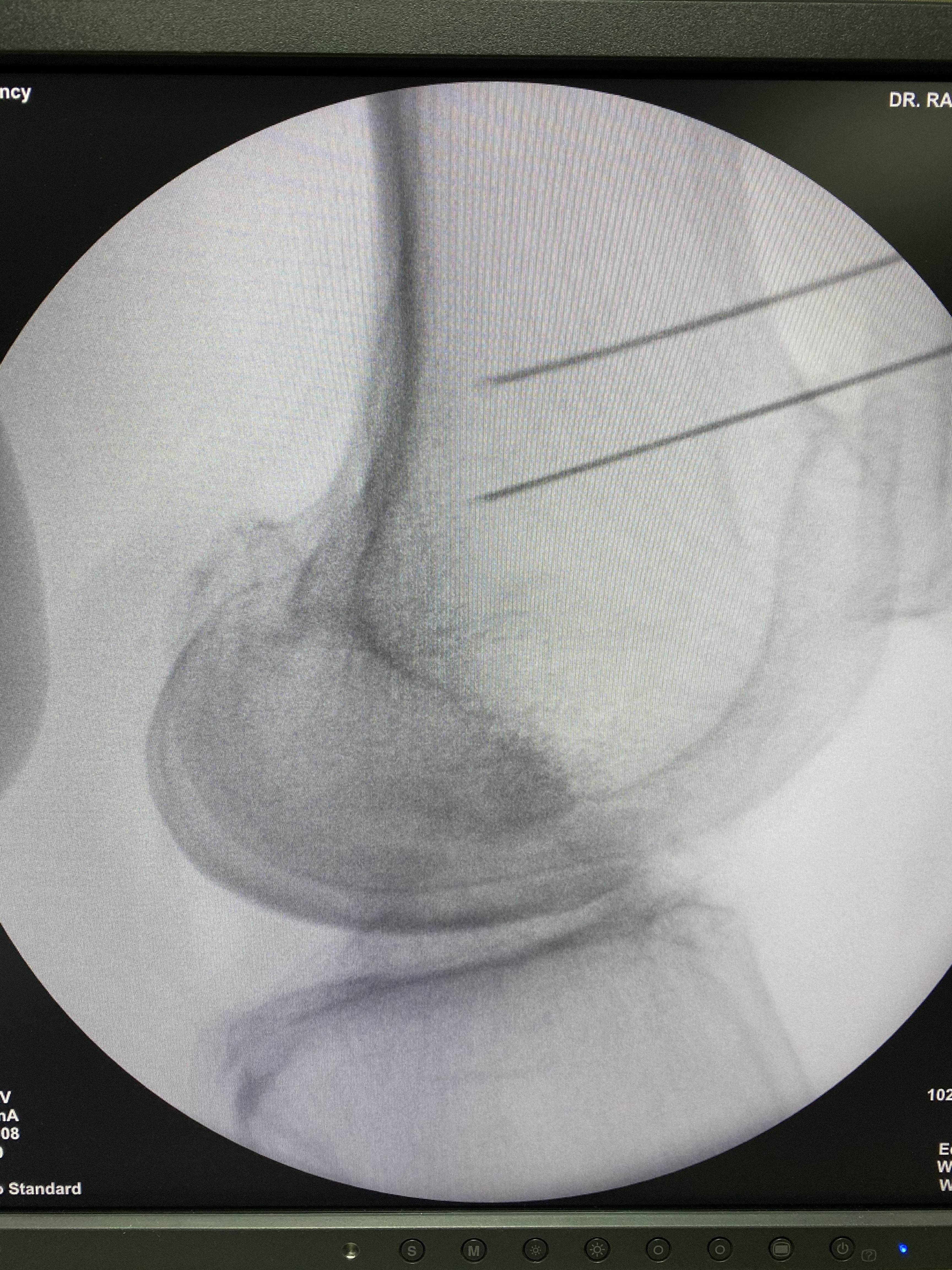 Radiofrecuencia en rodilla
